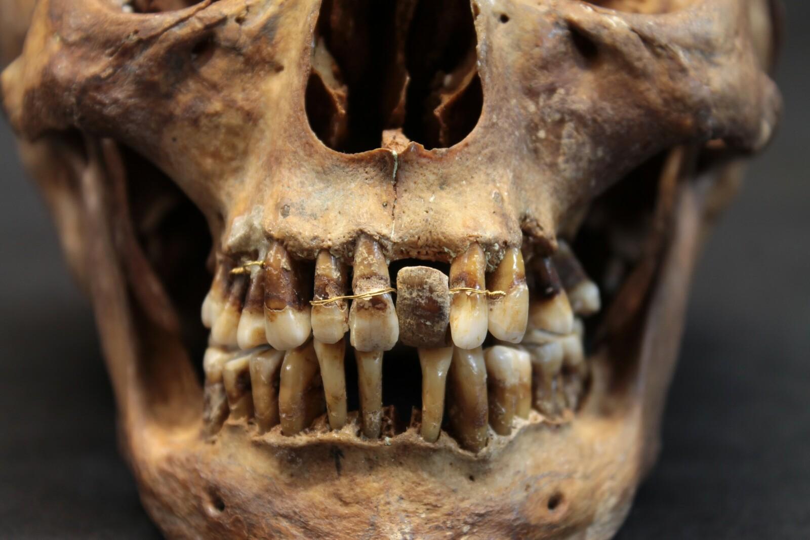 Crâne d'Anne d'Alègre, comtesse de Laval (1565-1619), équipé de prothèses dentaires aux fils d'or. Collection Musée de Laval. © Rozenn Colleter, Inrap